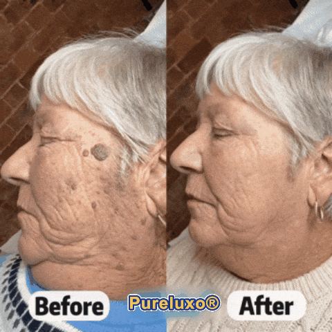 Pureluxo® Skin Tag Remover Roller💥💥