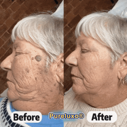 Pureluxo® Skin Tag Remover Roller💥💥