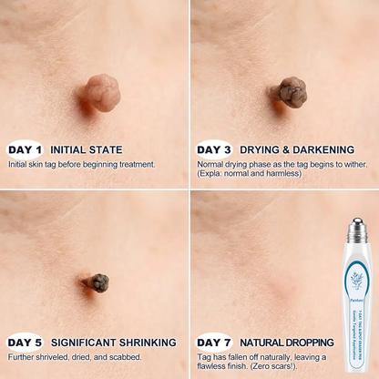 Pureluxo® Skin Tag Remover Roller💥💥